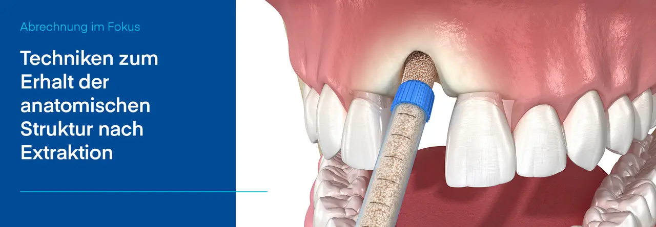 Grafische Darstellung einer Zahnlücke im Oberkiefer mit eingespritztem Knochenersatzmaterial zur Erhaltung des Kieferkamms; links Textblock: „Techniken zum Erhalt der anatomischen Struktur nach Extraktion“.