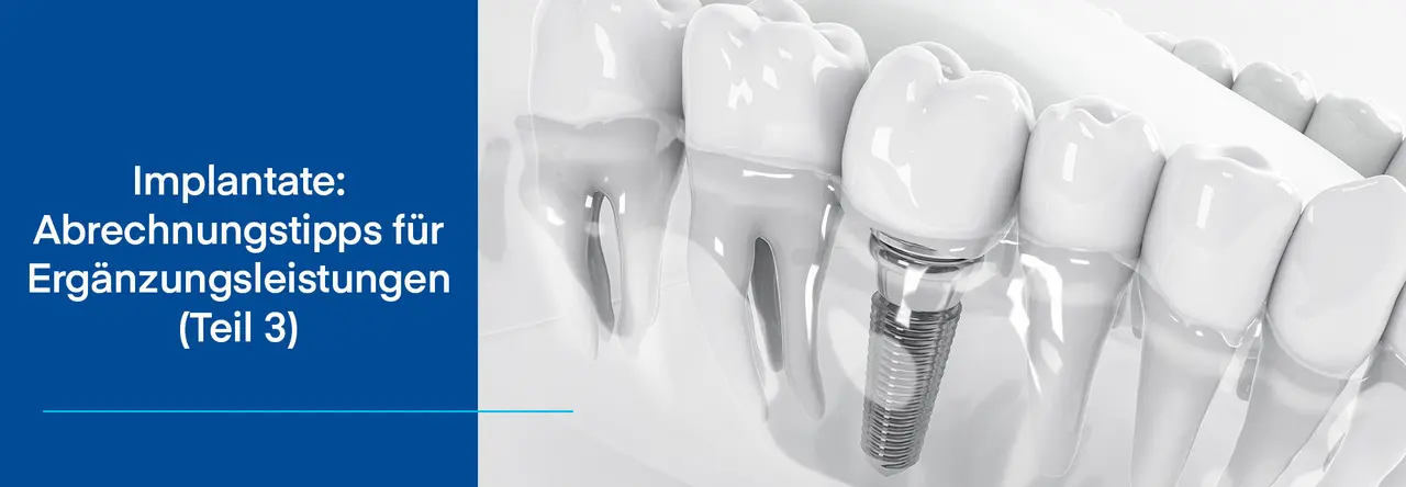 Zweigeteiltes Bild: Links blauer Hintergrund mit weißer Aufschrift "Implantate: Abrechnungstipps für Ergänzungsleistungen Teil 3" - rechts: Zahnimplantat