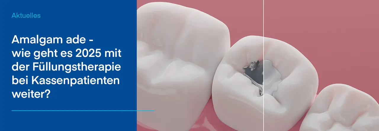 Darstellung eines stark vergrößerten Zahns mit einer Amalgamfüllung. Auf der linken Seite des Bildes befindet sich ein blauer Hintergrund mit der Überschrift 'Amalgam ade - wie geht es 2025 mit der Füllungstherapie bei Kassenpatienten weiter?'. Der Zahn mit der Füllung zeigt den Zustand eines Zahns vor und nach der Entfernung von Amalgam, dargestellt mit einem klaren Schnitt durch das Bild, um den Unterschied zu verdeutlichen.